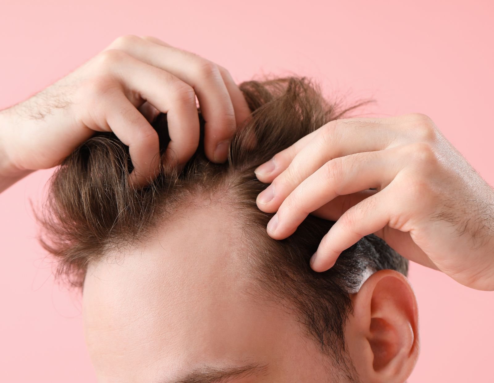 hair transplant
