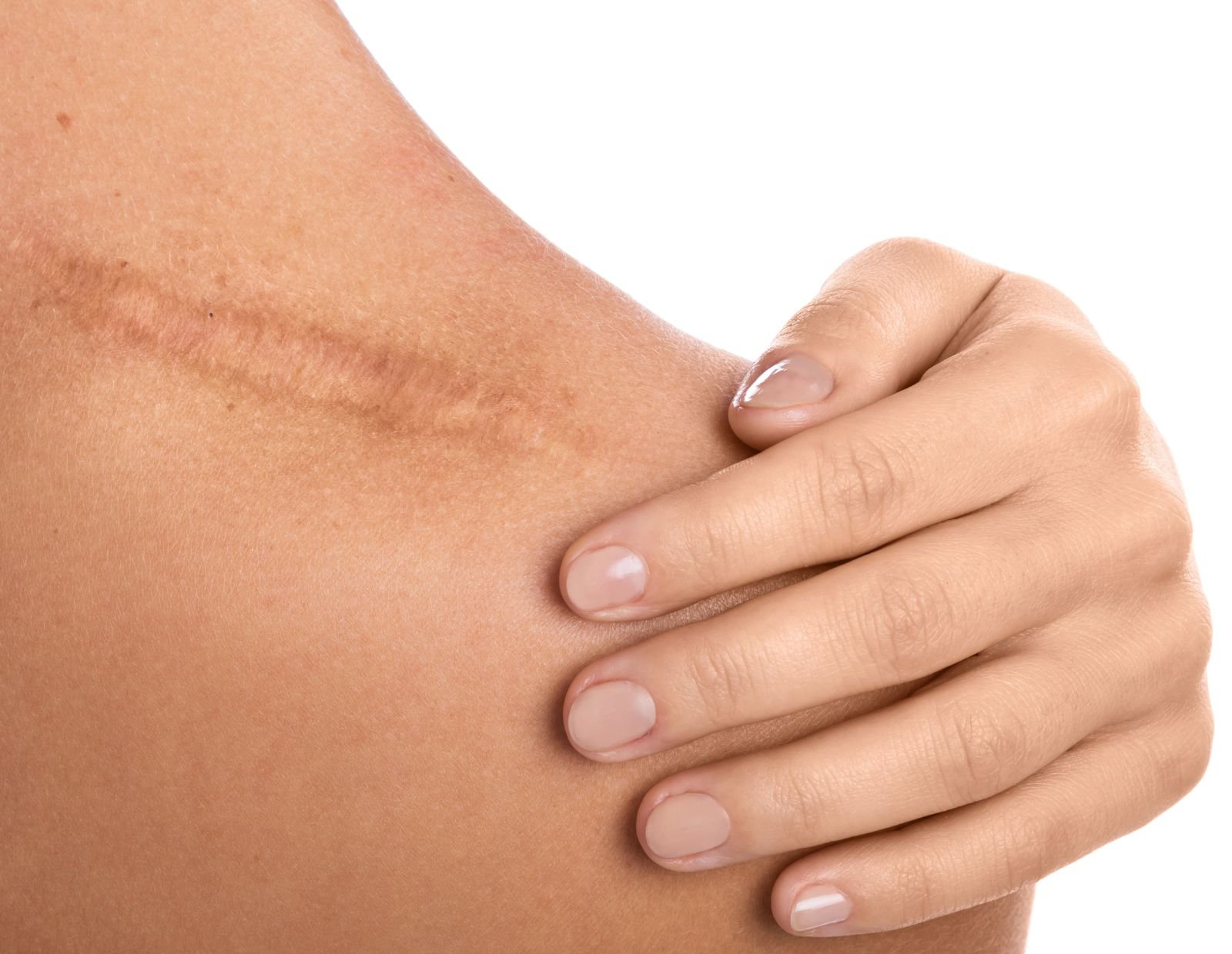 scar revision