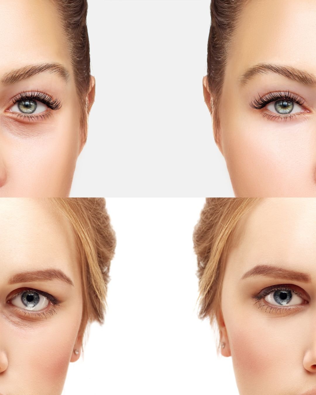 blepharoplasty 1