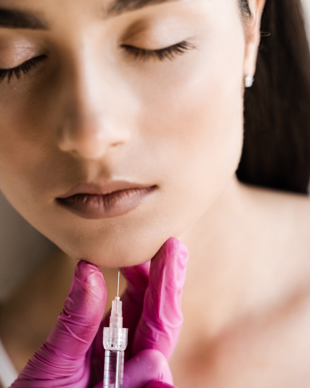 chin augmentation 4