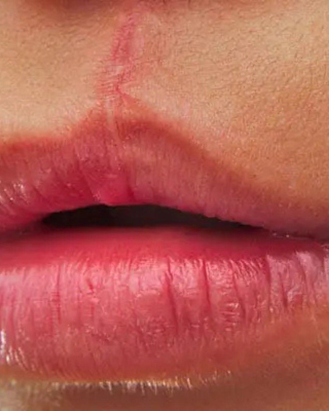 cleft palate surgery 4