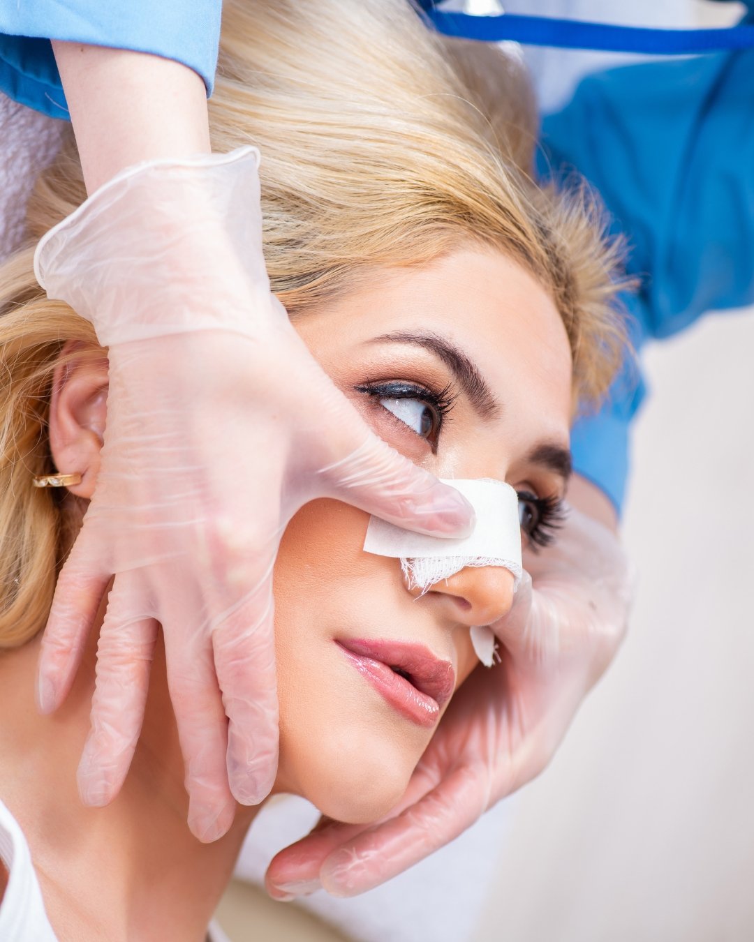 rhinoplasty 2